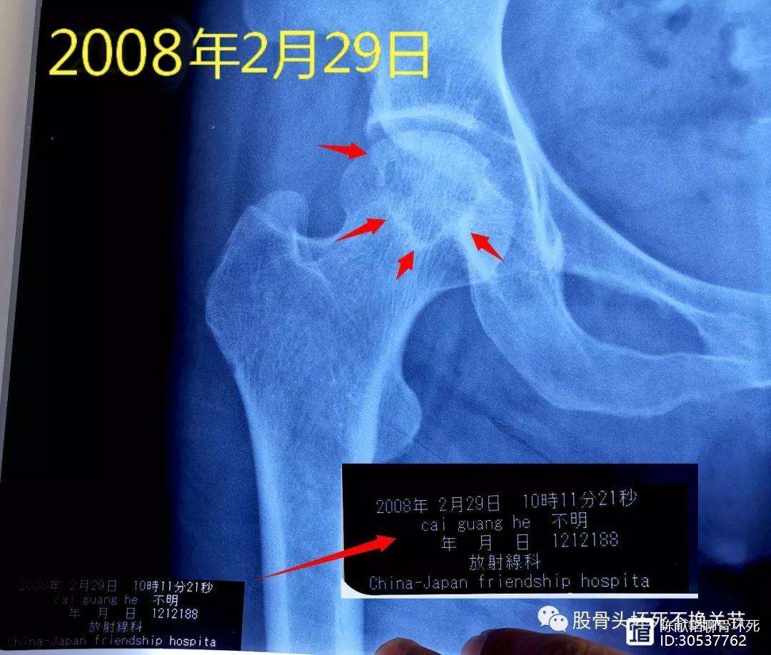 滨州人工骨头医保报销多少(人工骨头医保报销多少比例)