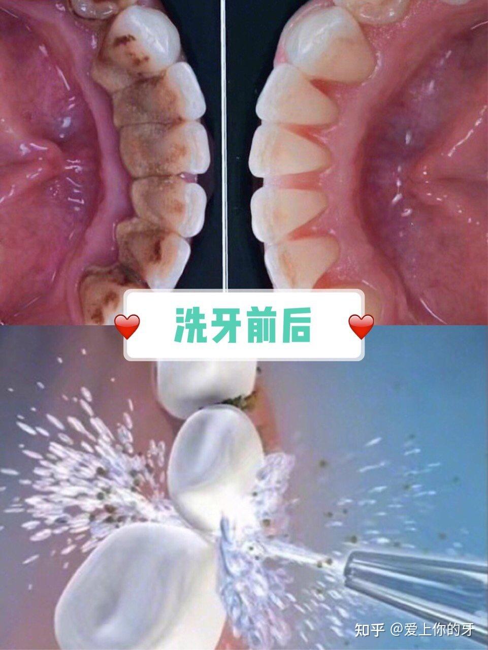 滨州洗牙可以用医保吗(洗牙可以用医保吗,报销比例多少)